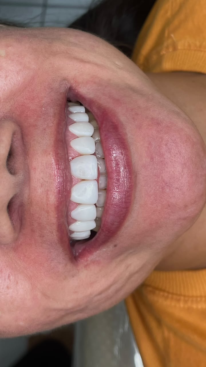 Facetas dentárias — depois do tratamento