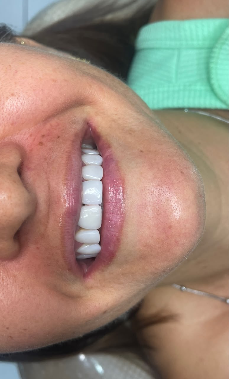 Implante dentário — depois do tratamento