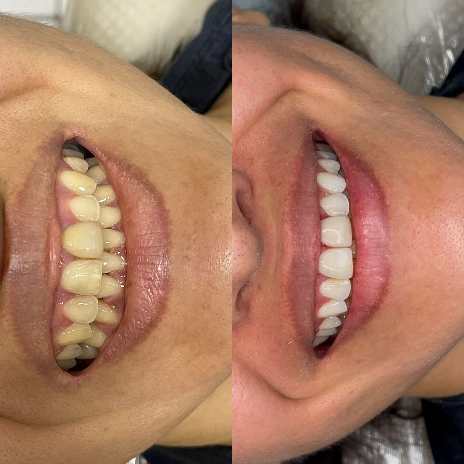 Clareamento dental — antes e depois