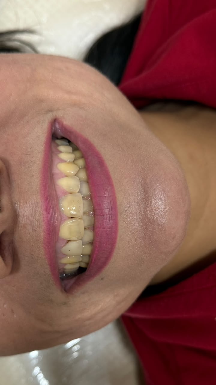 Facetas dentárias — antes do tratamento