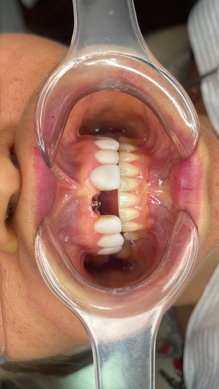 Implante dentário — antes do tratamento